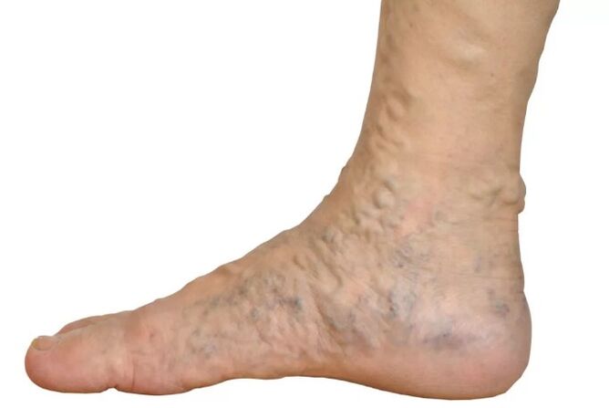 Veens diseases on the legs