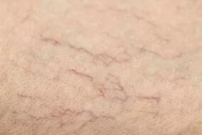 Vascular stars