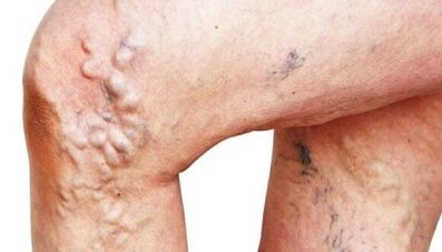 The main manifestations of varicose veins on the legs