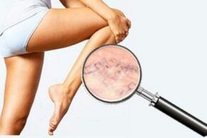 Vascular damage – mild varicose veins