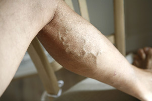 What is prohibited with varicose veins