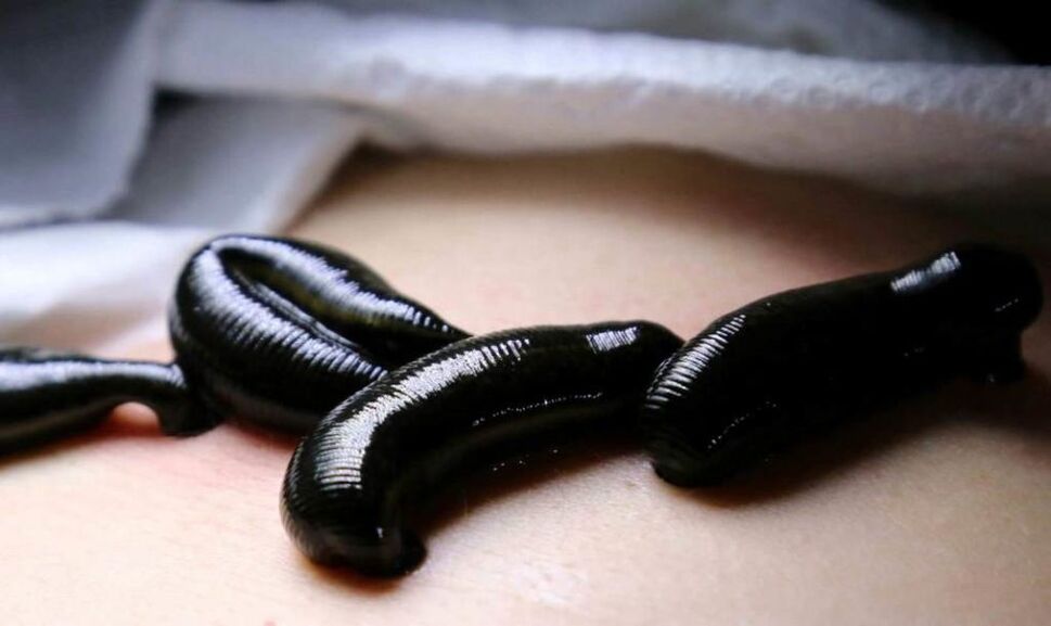 Treating varicose veins with leeches