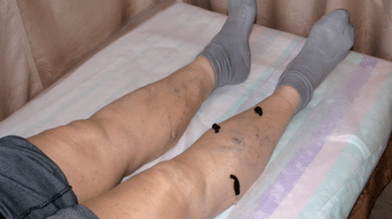 Treating varicose veins with leeches