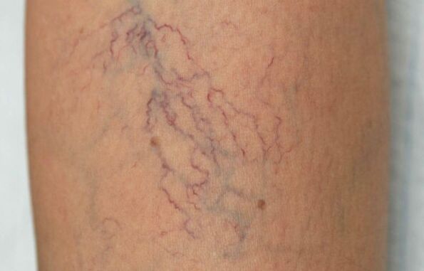 Varicose veins on the legs in women
