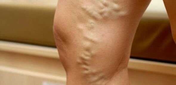 Varicose veins on women's legs