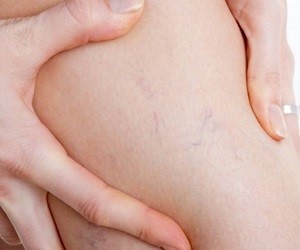 Methods of treating varicose veins