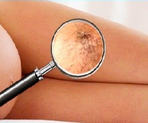 Treatment of varicose veins with folk remedies