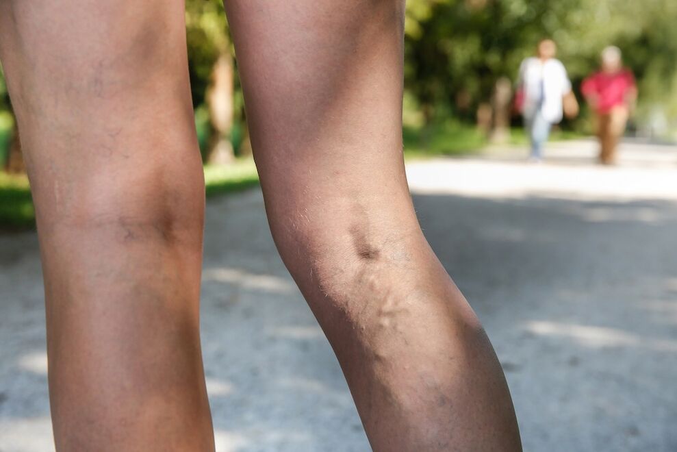 Varicose veins on the legs