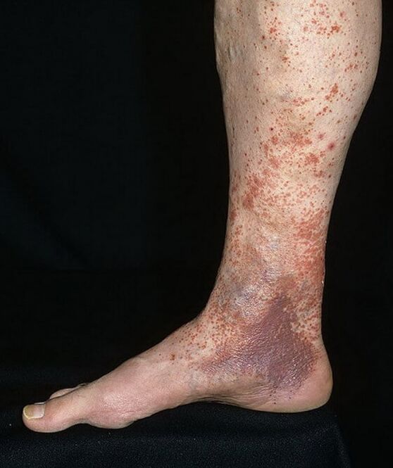 Cramp dermatitis