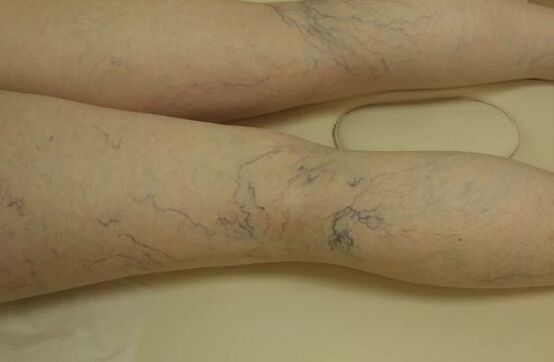 Cramp stars on the legs
