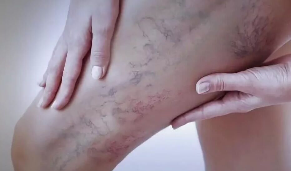 Stars on the legs with varicose veins