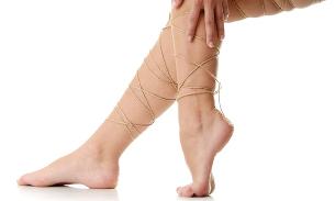 Varicose veins of the lower extremities