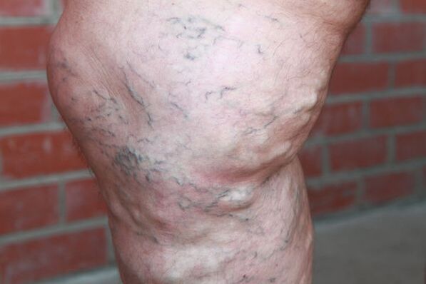 Signs of varicose veins