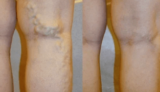 Signs and symptoms of varicose veins on the legs in men