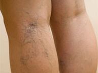 Varicose veins in the legs