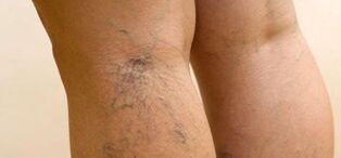 Varicose veins in the legs