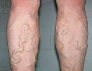 3rd degree varicose veins in the legs