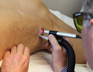 Contraindications to the treatment of varicose veins with a laser