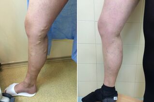 Laser treatment of varicose veins before and after photos