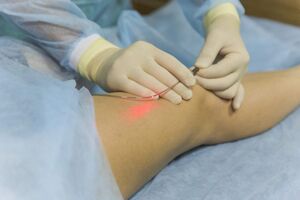 Laser treatment of varicose veins is the essence of the procedure