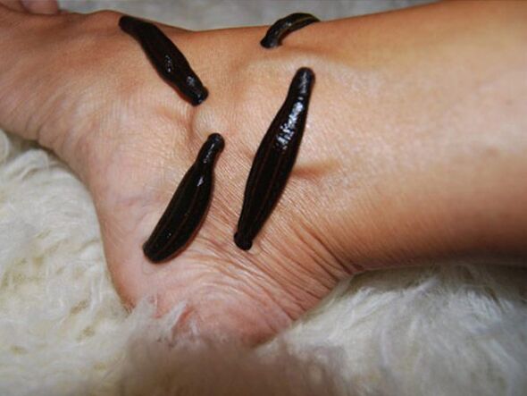 Treatment of varicose veins of the legs with leeches