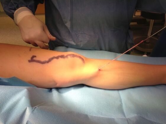 Stripping of veins with varicose veins