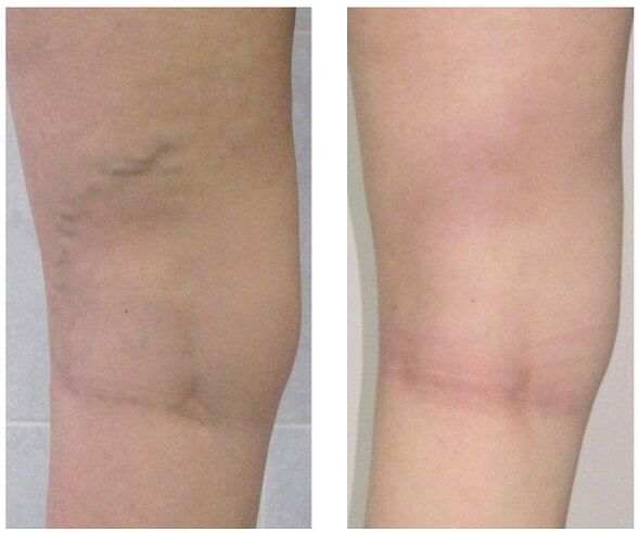 Leg vein before and after varicose vein treatment