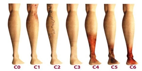 Stages of development of varicose veins on the legs