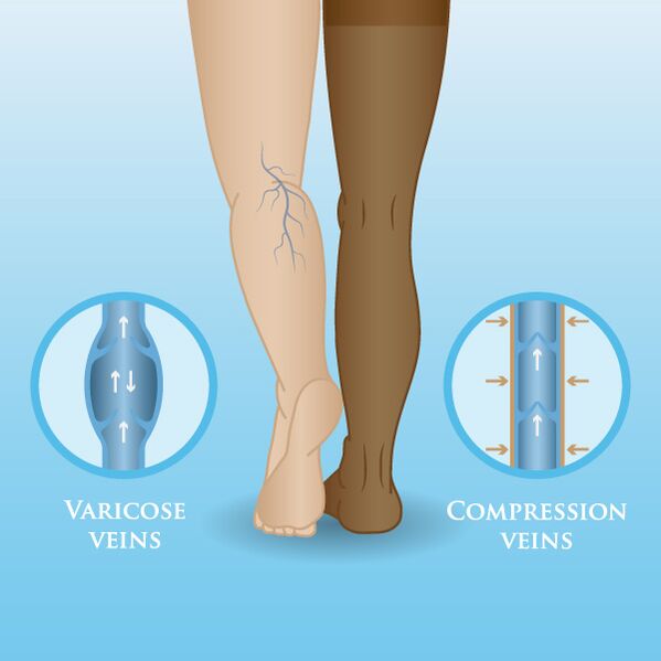 Effects of compression garments on varicose veins in the legs