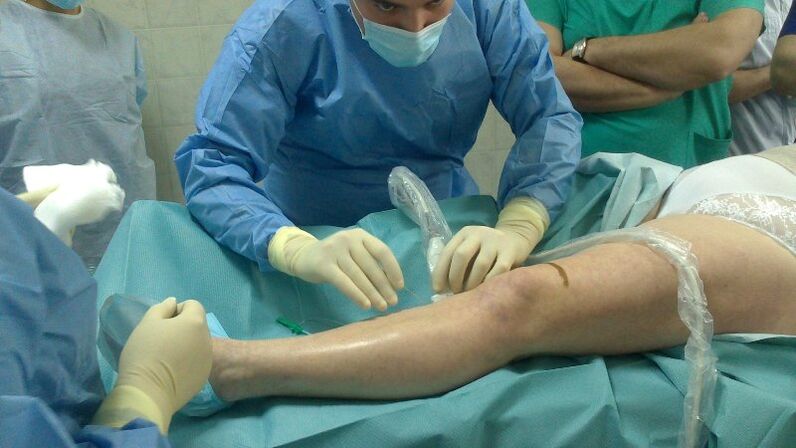 operative treatment of varicose veins