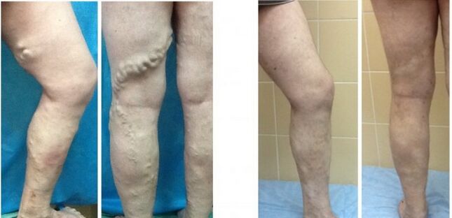 Legs before and after radiofrequency obliteration of veins with varicose veins