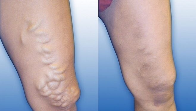 Legs before and after severe varicose veins treatment