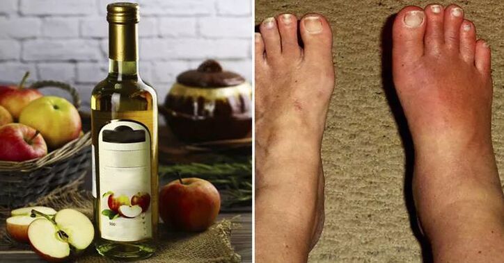 Apple cider vinegar for swelling of the feet