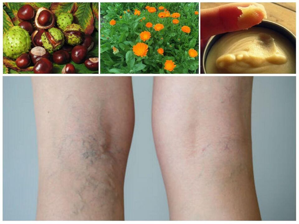 Varicose veins on the legs and folk remedies for prevention