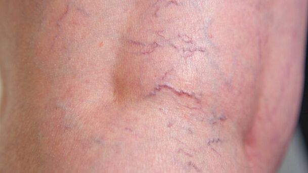 Signs of reticular varicose veins of the lower extremities - dilation of fine veins and vascular networks