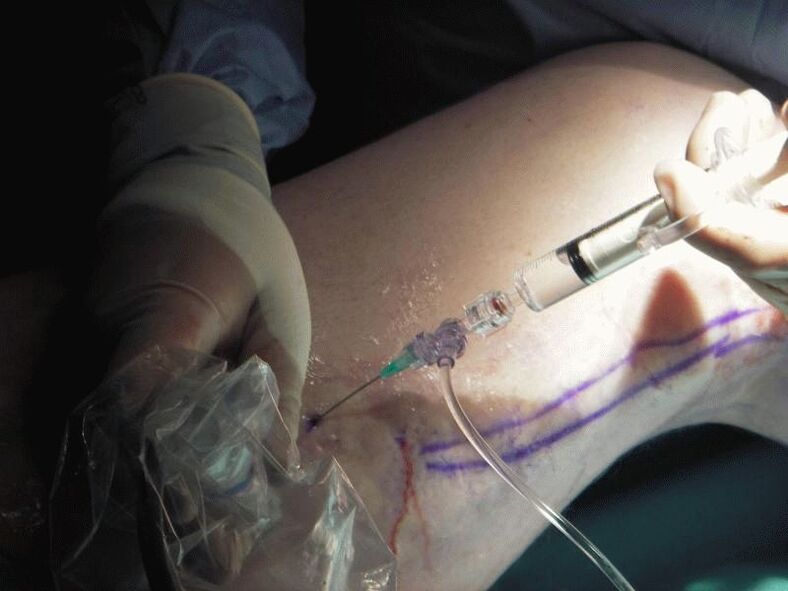 Sclerotherapy as a means of treating varicose veins