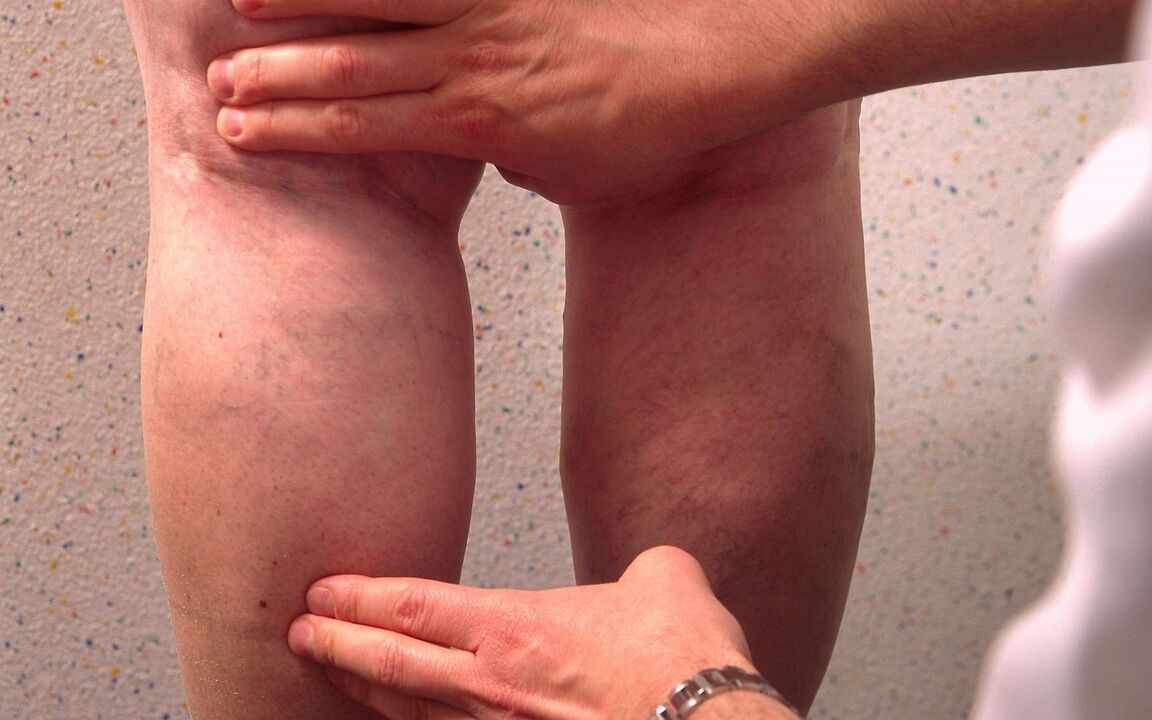 the doctor examines the legs with varicose veins