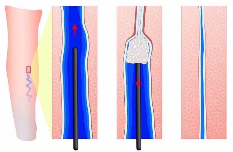 Sclerosing of varicose veins in the legs in men