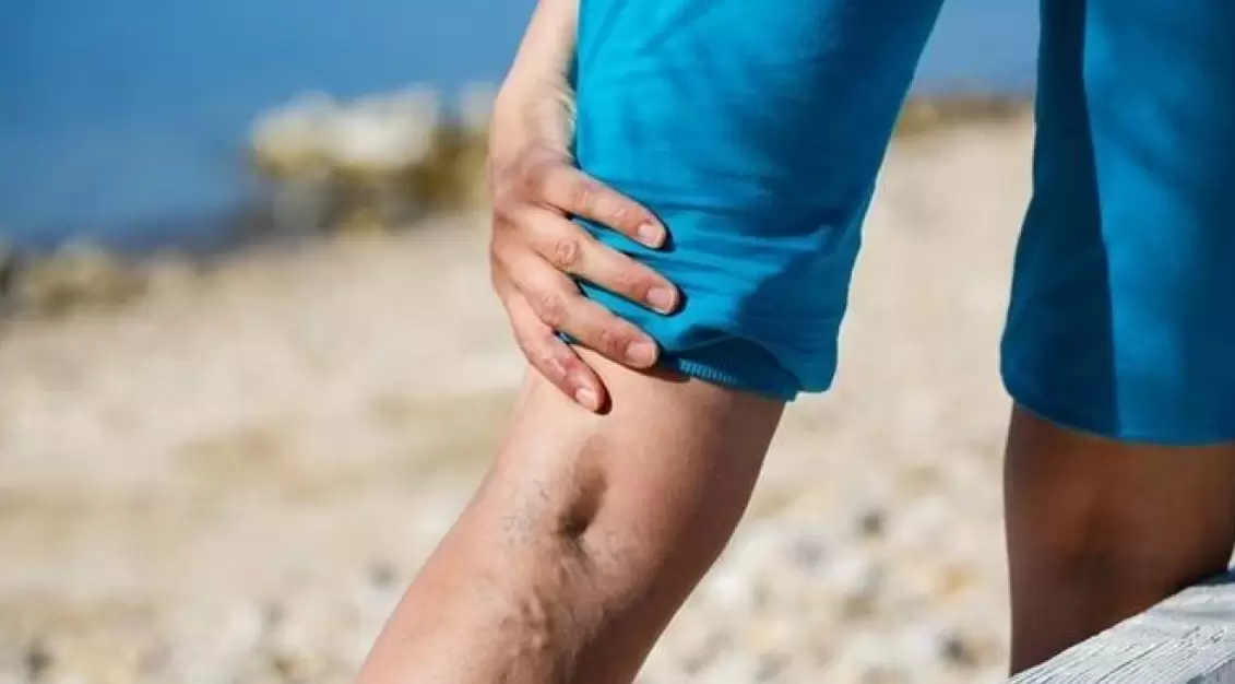 Protruding blue veins on the legs are a sign of varicose veins