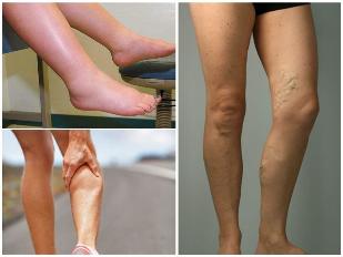 Consequences of varicose veins